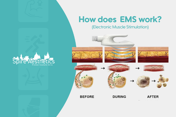 EMS treatment for post pregnancy weight loss treatment Bury St Edmunds