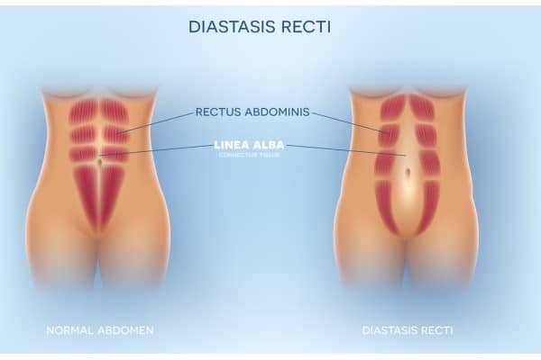 What Non-Surgical Options Are Available for Diastasis Recti Bury St Edmunds?