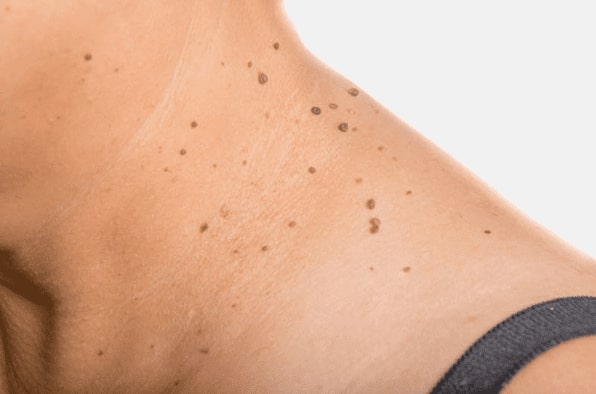 Are you looking for easy skin tag removal Bury St Edmunds - then contact Spire today!
