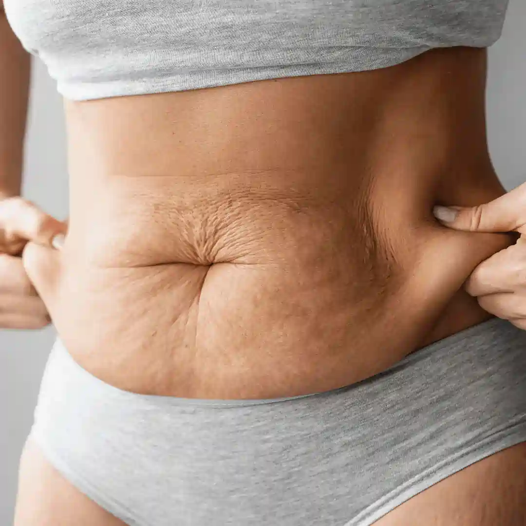 Is It Normal to Have Loose Skin After Pregnancy Bury St Edmunds?